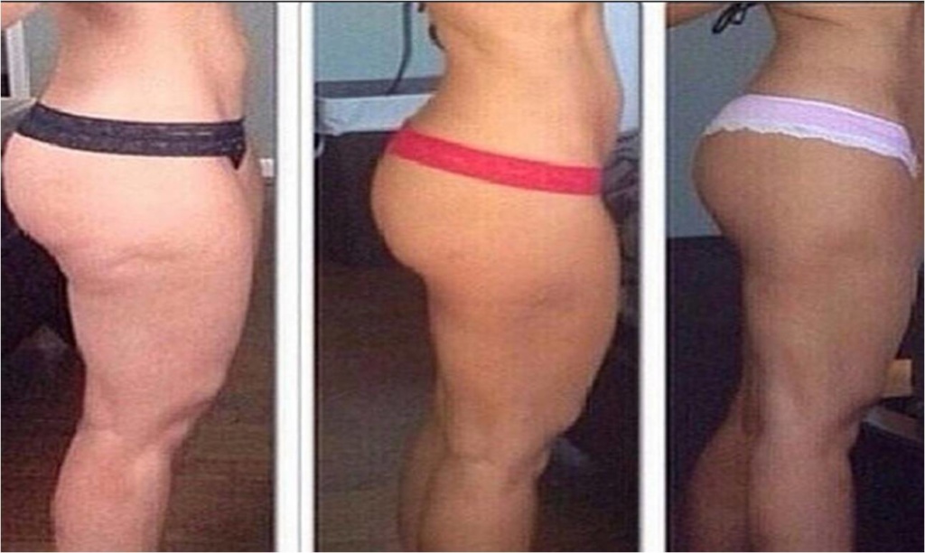 cellulite-in-thighs